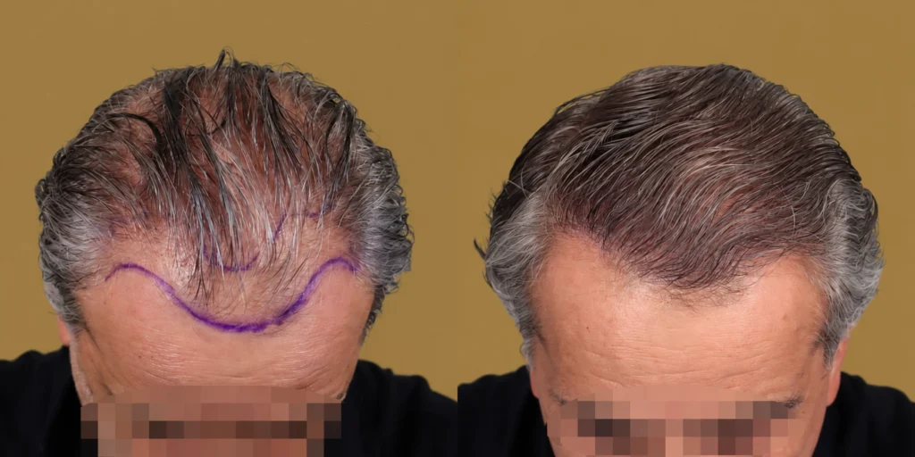 hair-transplant-in-mexico-city