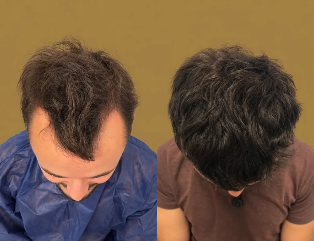 hair-transplant-in-mexico-city