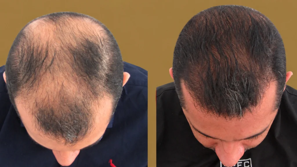 hair-transplant-in-mexico-city