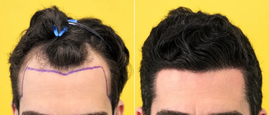 1,800 Grafts — Hairline Restoration
