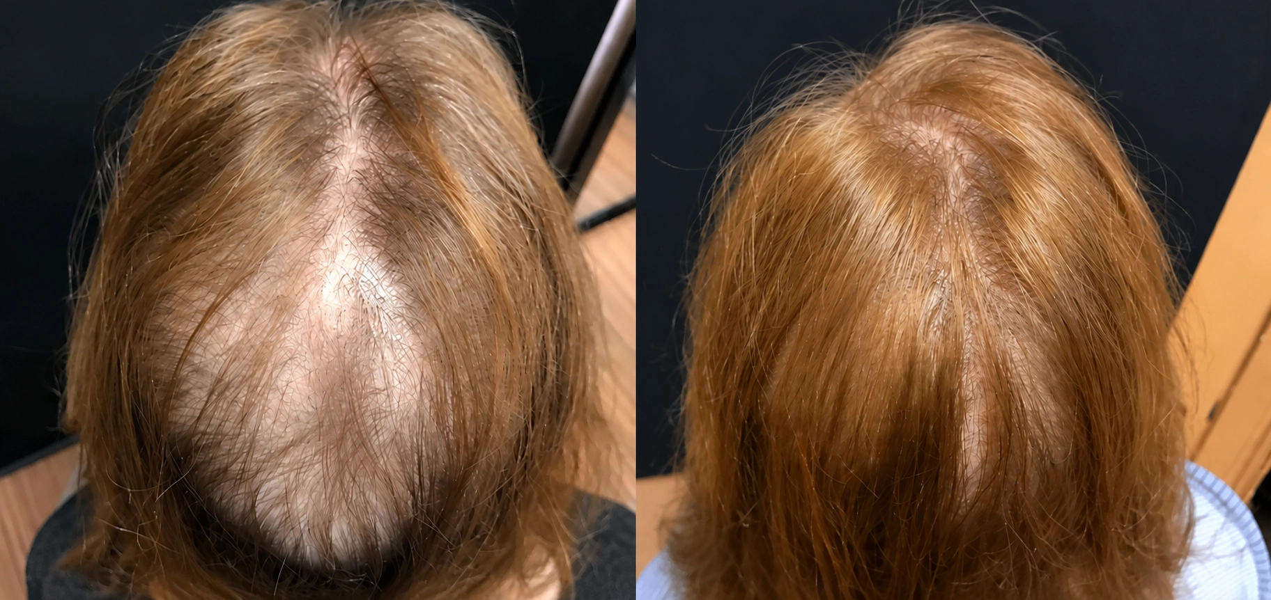 long-hair-fue
