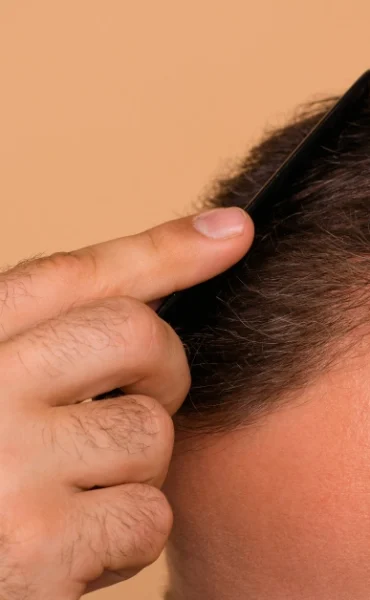 hair-transplant-in-southern-mexico (1)