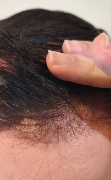 hair-transplant-ugly-duckling-phase