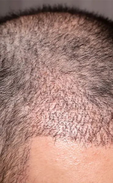 hair-transplant-vs-plugs